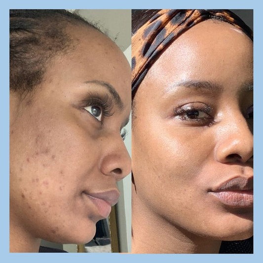 Sérum Anti-Tache Visage - Kora Market